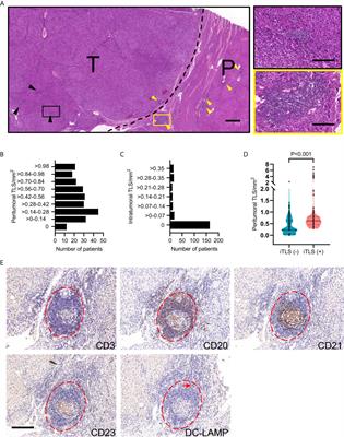 Peritumoral Tertiary Lymphoid Structures Correlate With Protective Immunity and Improved Prognosis in Patients With Hepatocellular Carcinoma